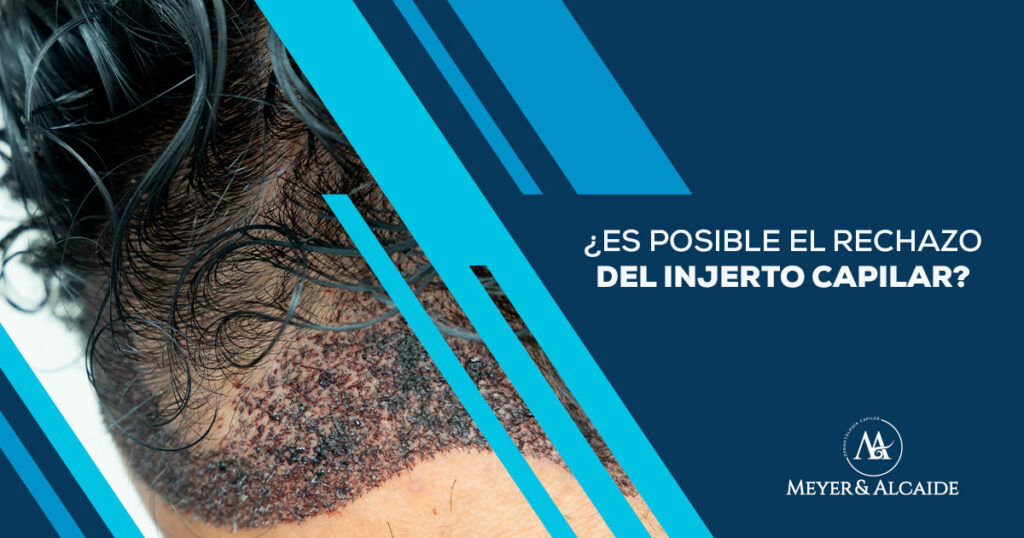 RECHAZO-DEL-INJERTO-CAPILAR-1200x630-1